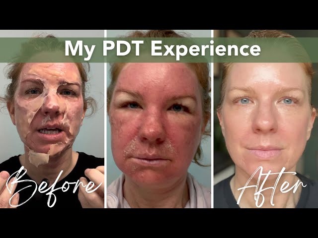 Photodynamic Therapy (PDT) | Skin Cancer Prevention & Actinic Keratosis Treatment
