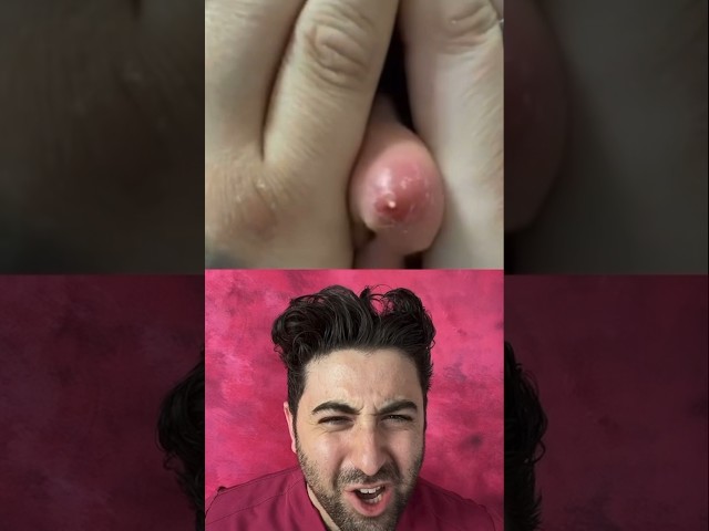 What kind of pimple pop is between this person’s hands ?