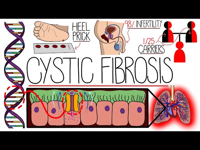 Understanding Cystic Fibrosis (Includes Pathophysiology & Diagnosis)