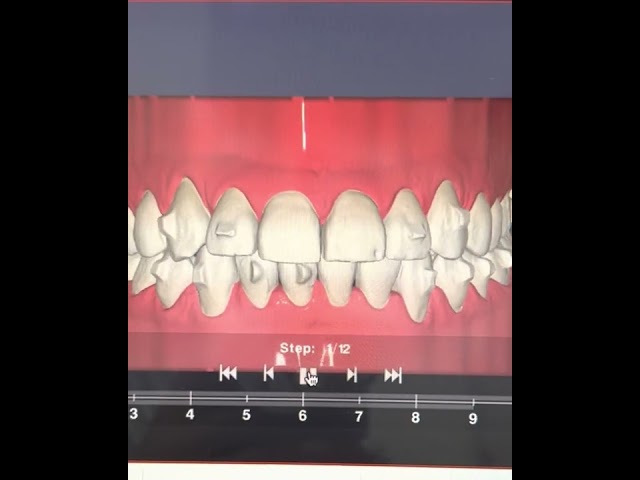 ¡Ortodoncia sin brackets!