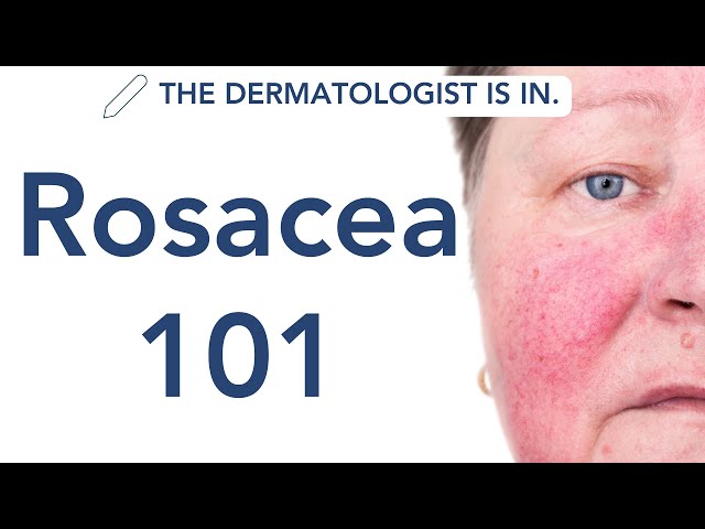 Rosacea Explained: What Rosacea is & the Best Ways to Treat It Effectively | Dermapedia