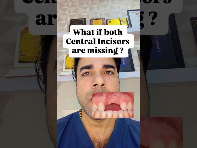 BOTH CENTRAL INCISORS MISSING #dentaleducation #dentaltips #dentistry #dentalexperts #dentalshorts