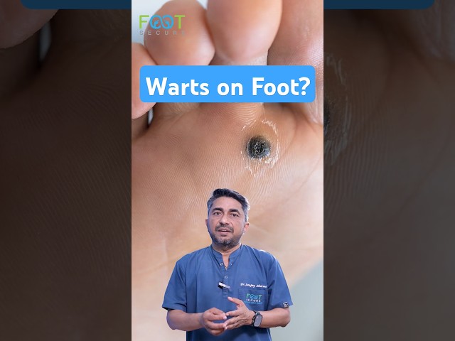 Causes of foot warts | Plantar warts #warts #footsurgeon