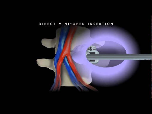 ROI-A Oblique ALIF Cage