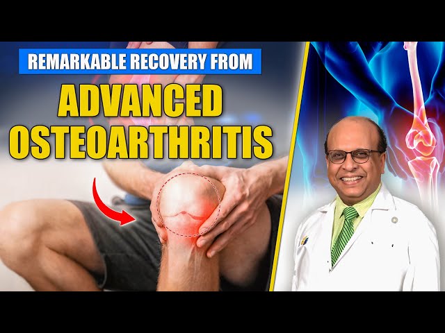 Advanced osteoarthritis in the right Hip