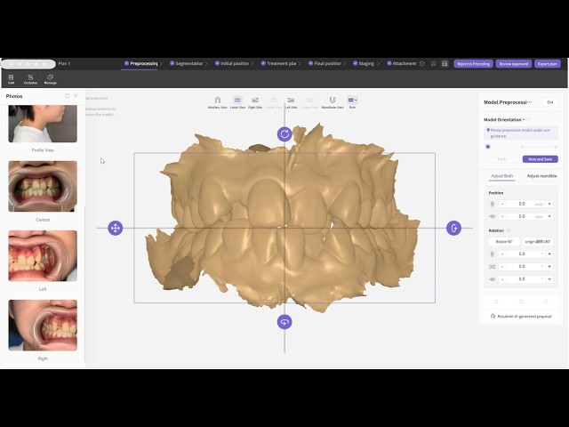 EM Clear Aligner Treatment Case | Angle Class I & Grade III Severe Anterior Crowding | Extraction