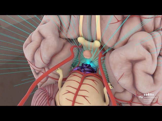 Pediatric Arteriovenous Malformations (AVMs) Treatment Options | UCSF Pediatric Brain Center