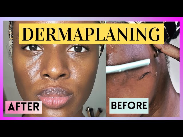HOW TO DERMA PLAN || PREP YOUR SKIN FOR A CLEARER SMOOTHER GLOWING SKIN