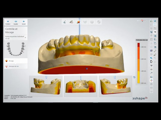 Importer et modifier un cas dans 3Shape