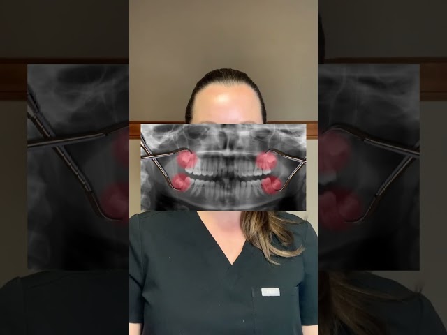Should you get your wisdom teeth removed? #drwindhorst #choiceorthodontics #wisdomteeth