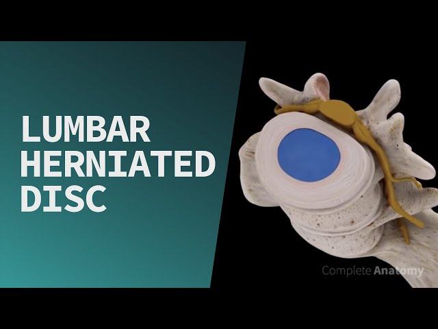 Lumbar Herniated Disc