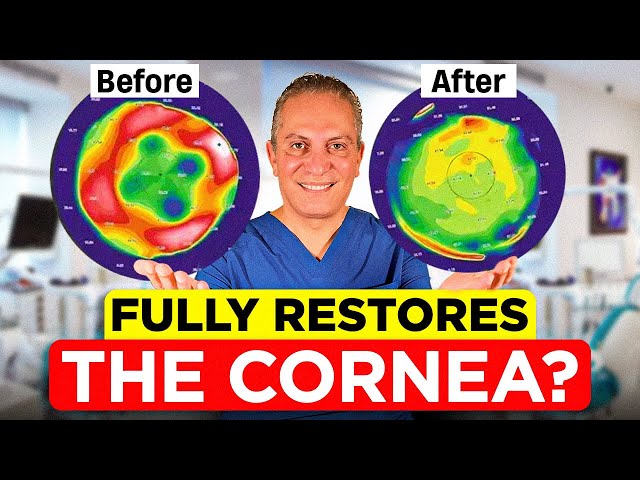 What is Topography-Guided PRK? | Is This The Best Treatment for Astigmatism?
