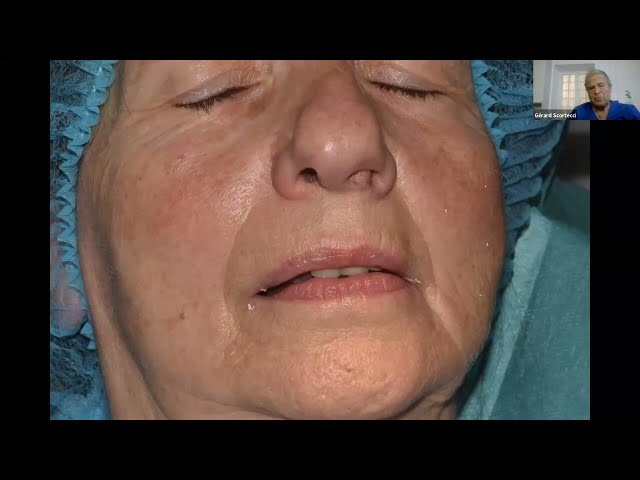 Use of oblique implants in the parasinus and parasymphysis zones