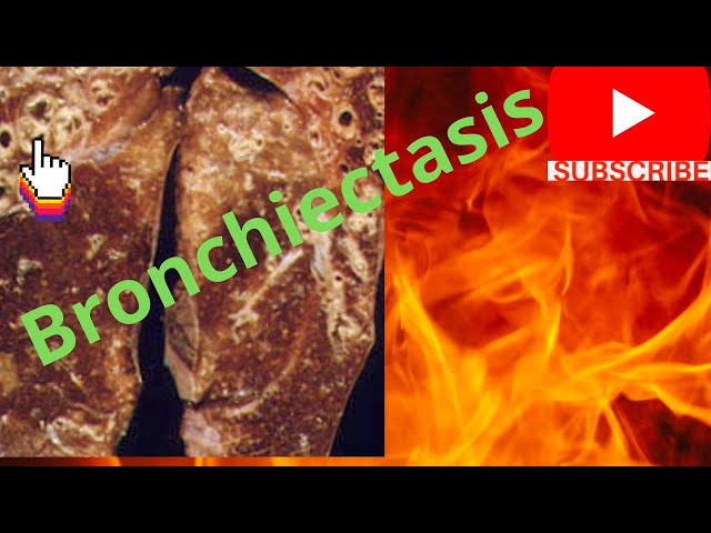 ?Most Common Causes Of Bronchiectasis What Causes Bronchiectasis| Popular Video