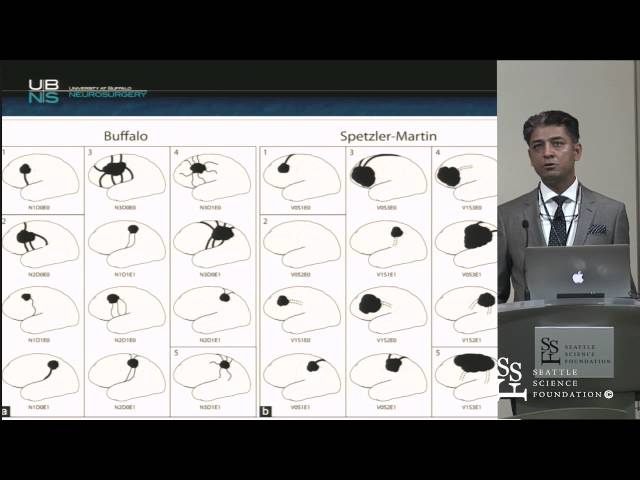Expectations & Limitations of Embolization for AVM by Adnan Siddiqui, M.D.