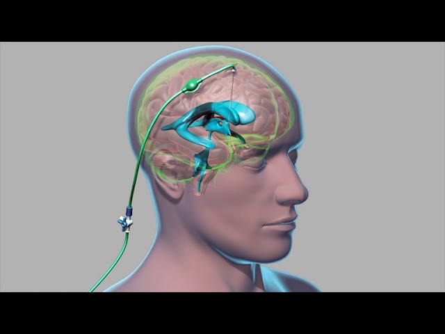 External Ventricular Drain (EVD)