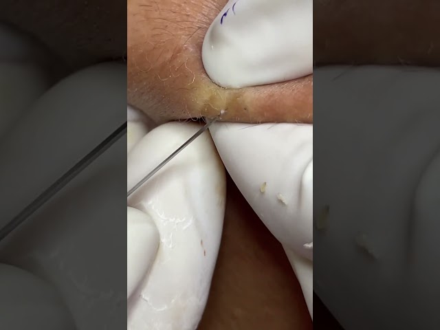 Hidden Acne 036