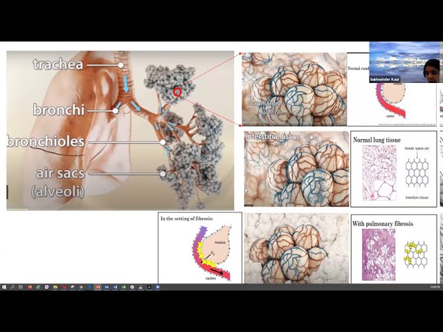 CoronaWhy - #TeamPulmonaryFibrosis - Computer Vision and Deep Learning for Medical Screening