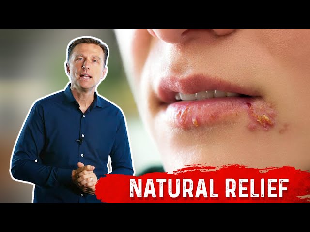 What is Herpes? – Types of Herpes & Remedies Covered by Dr.Berg