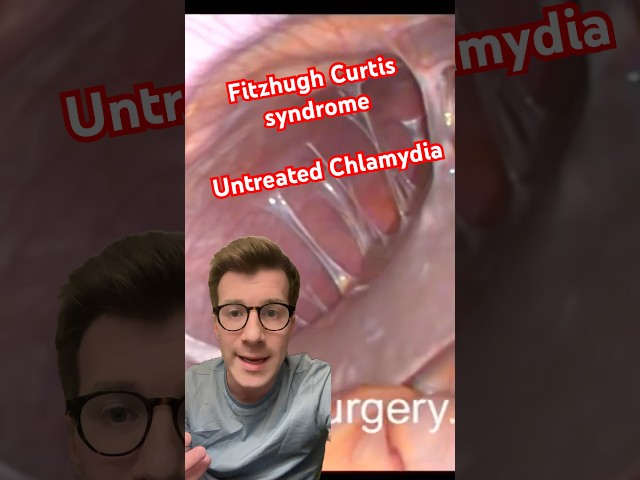 A complication of UNTREATED CHLAMYDIA or GONORRHEA (Fitz Hugh Curtis) #shorts