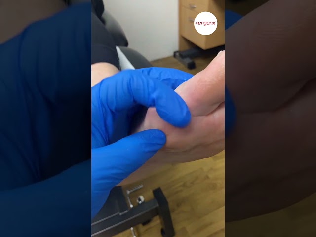 Bunion Joint Callus Removal