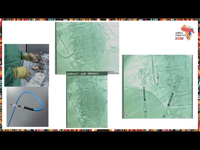 Case Study: Complications - LBB Lead Dislodgement - Using Resources at Hand in Austere Environments