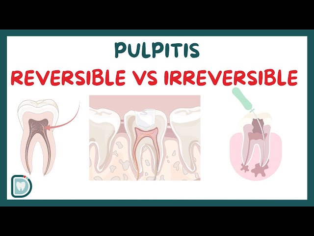 Reversible Pulpitis Vs Irreversible Pulpitis: Symptoms, Diagnosis, Testing, and Management
