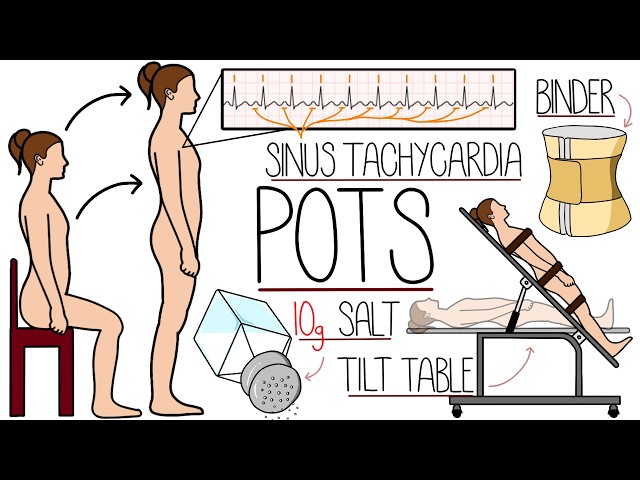 Postural Orthostatic Tachycardia Syndrome (POTS) Explained Clearly