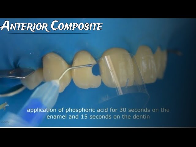 Class III Composite restoration Full case protocol from A to Z