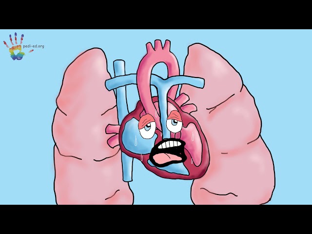 What is a Patent Ductus Arteriosus or PDA?