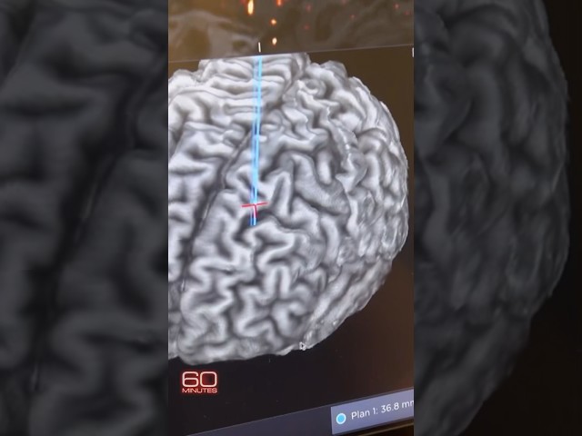 A cutting-edge approach to brain surgery with no cutting #shorts