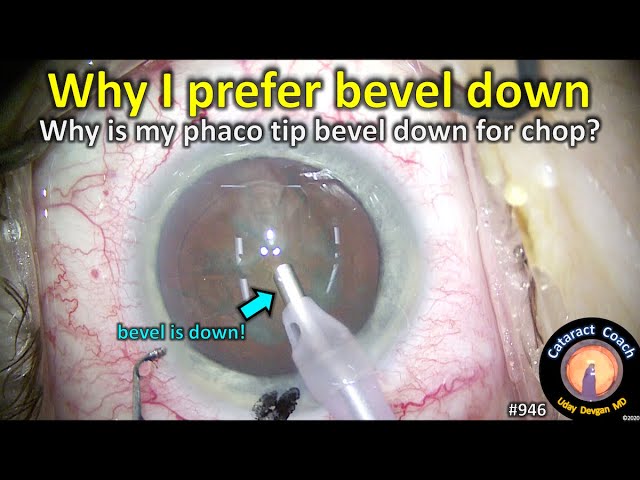 This is why I prefer bevel down for phaco chop cataract surgery