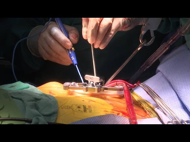 How minimally invasive heart surgery is changing lives