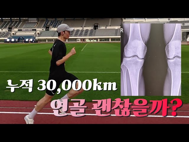 3만km 뛴 무릎 엑스레이를 본 의사의 첫마디