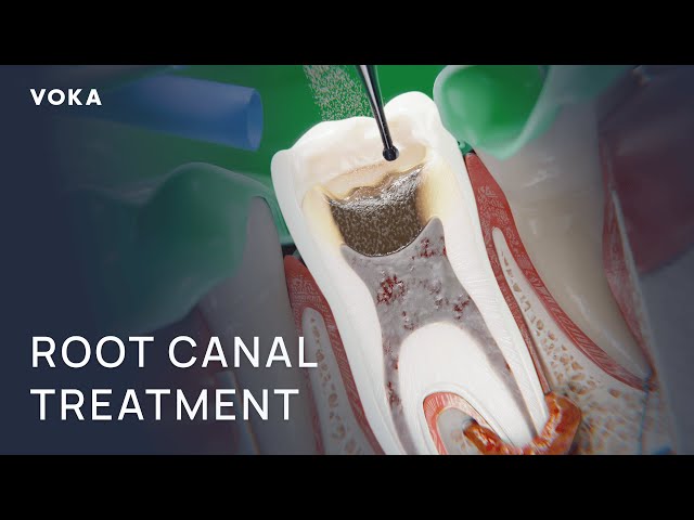Root Canal Treatment | VOKA 3D medical animation