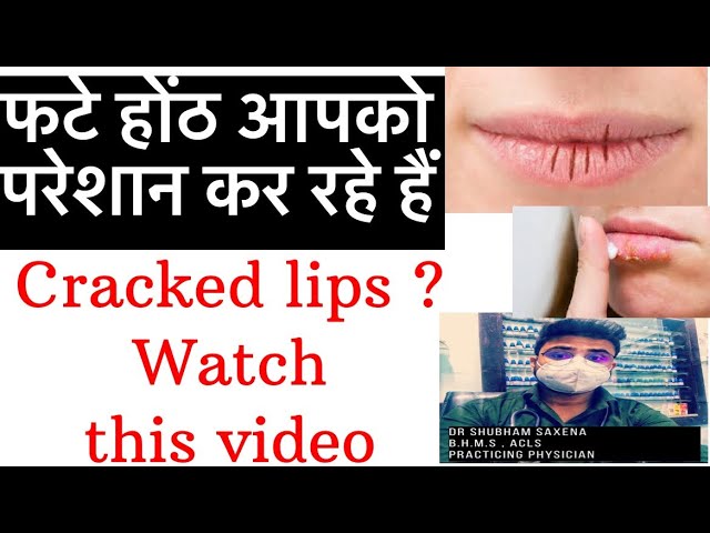 Lips / glossy lips / crack lips / homeopathy medicine / dryness in lips / lips dry / cracks