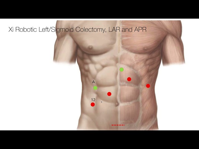 Trocar Placement Robotic Left/Sigmoid Colectomy