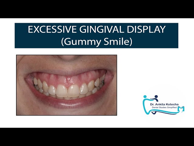 EXCESSIVE GINGIVAL DISPLAY (GUMMY SMILE)| CLASSIFICATION| PRETREATMENT EVALUATION OF GUMMY SMILE