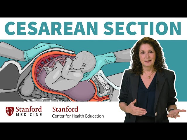 What is a cesarean section? OB/GYN answers 13 common questions about c-sections | Stanford
