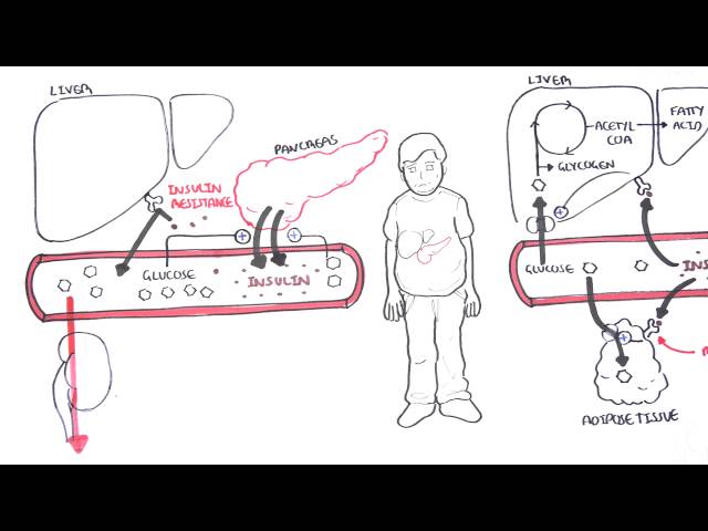 Diabetes Type II Pathophysiology
