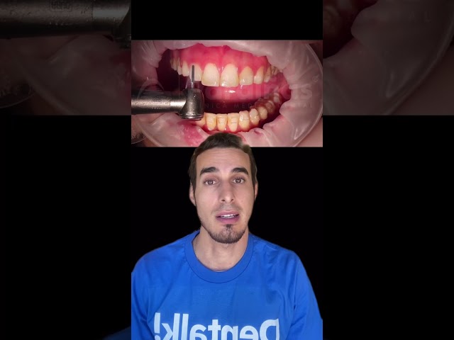 Brace Removal Step by Step - How to Remove Orthodontics