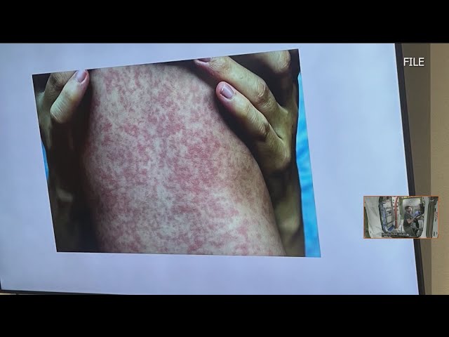Measles
