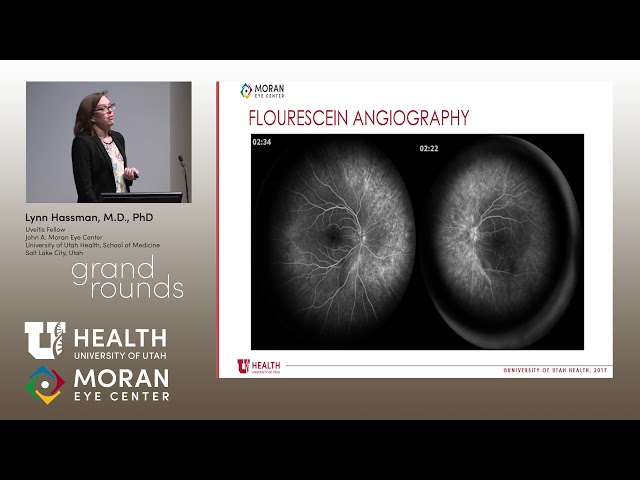 Update on Autoimmune Retinopathy [ARCHIVE]