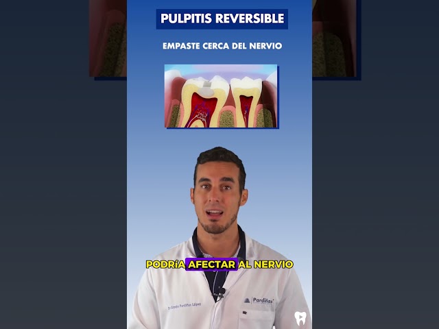 Estas son las CAUSAS de la PULPITIS reversible o INFLAMACIÓN del NERVIO DENTAL
