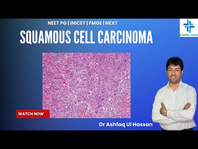 Squamous Cell Carcinoma  I FMGE I NEET Pg I USMLE I PLAB I INICET I MRCP
