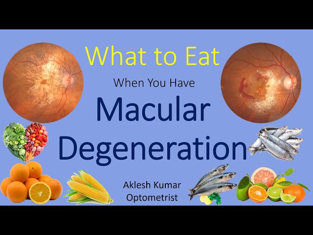 What to Eat When You Have Macular Degeneration | ARMD | Wet ARMD | Dry ARMD