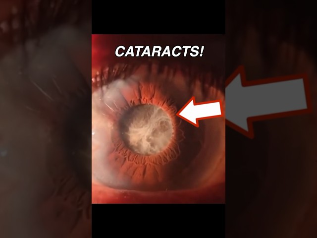 Doctor Explains: How CATARACTS Form! 👁️☁️