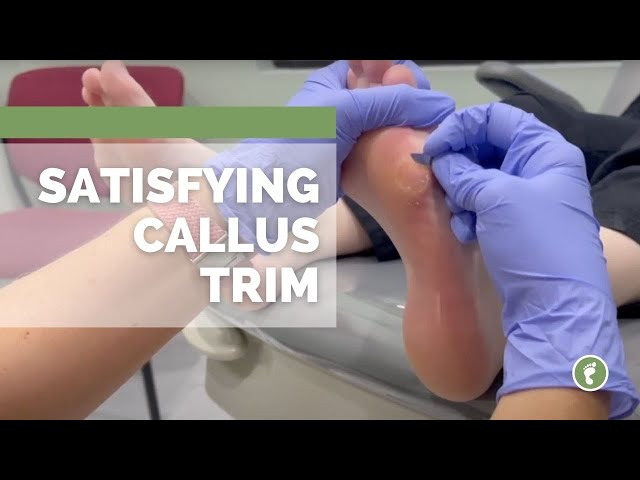 SATISFYING CALLUS TRIM 🔪
