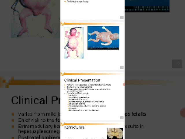 Lecture 49 : Hemolytic Disease of Newborn-HDN