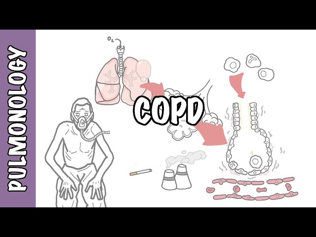 Understanding COPD - Chronic obstructive pulmonary disease cause, pathophysiology and treatment